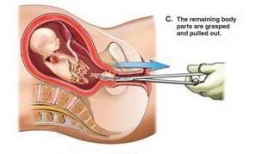 人工流产视频,视频背后的真相与反思